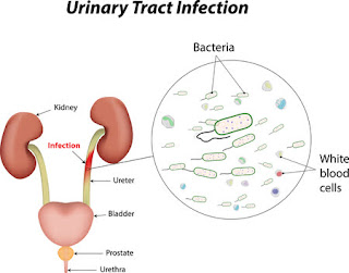 urinary tract infection