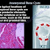 Aneurysmal bone cyst