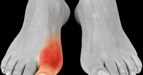 Homeopathy Lembut, Selamat dan Boleh Dipercayai: Gout 