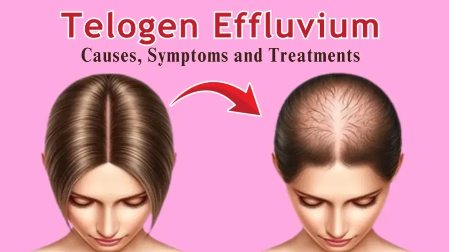 Telogen Effluvium Hair Loss