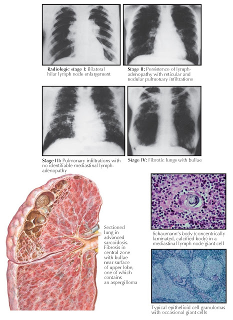 SARCOIDOSIS