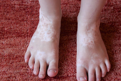 Vitiligo in Feet