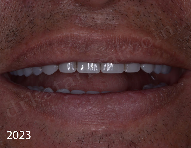 Happy Dental Patient with Denture
