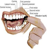 wisdom tooth, wisdom tooth abscess, infected wisdom tooth, wisdom tooth pain, impacted wisdom tooth
