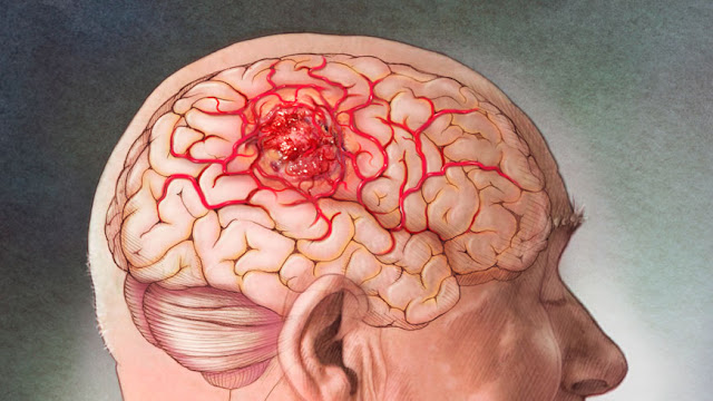 Cerebral Cavernoma