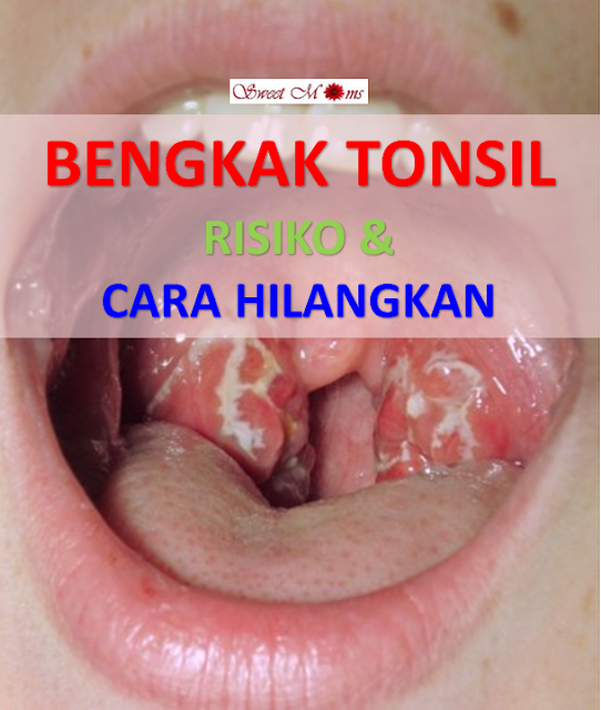 3 Cara Mudah Hilangkan Bengkak Tonsil, Elak Pembedahan  * SWEET MOMS VITAMIN :: Cantik dan 