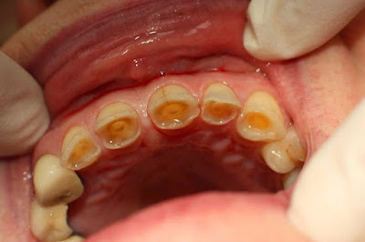 Khắc phục răng mòn mặt nhai với phương pháp bọc răng sứ