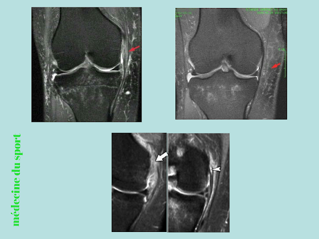 IMAGERIE DU GENOU APPLIQUÉE A LA PATHOLOGIE SPORTIVE