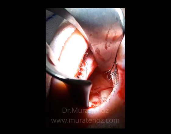 Repair of nasal septum perforation with rib cartilage - Reapiring of septum peforation - Closure of nasal septum perforation with rib cartilage - Nasal septum perforation rapairing surgery - Treatment of large septal perforation - Nasal septum perforation repair in Istanbul