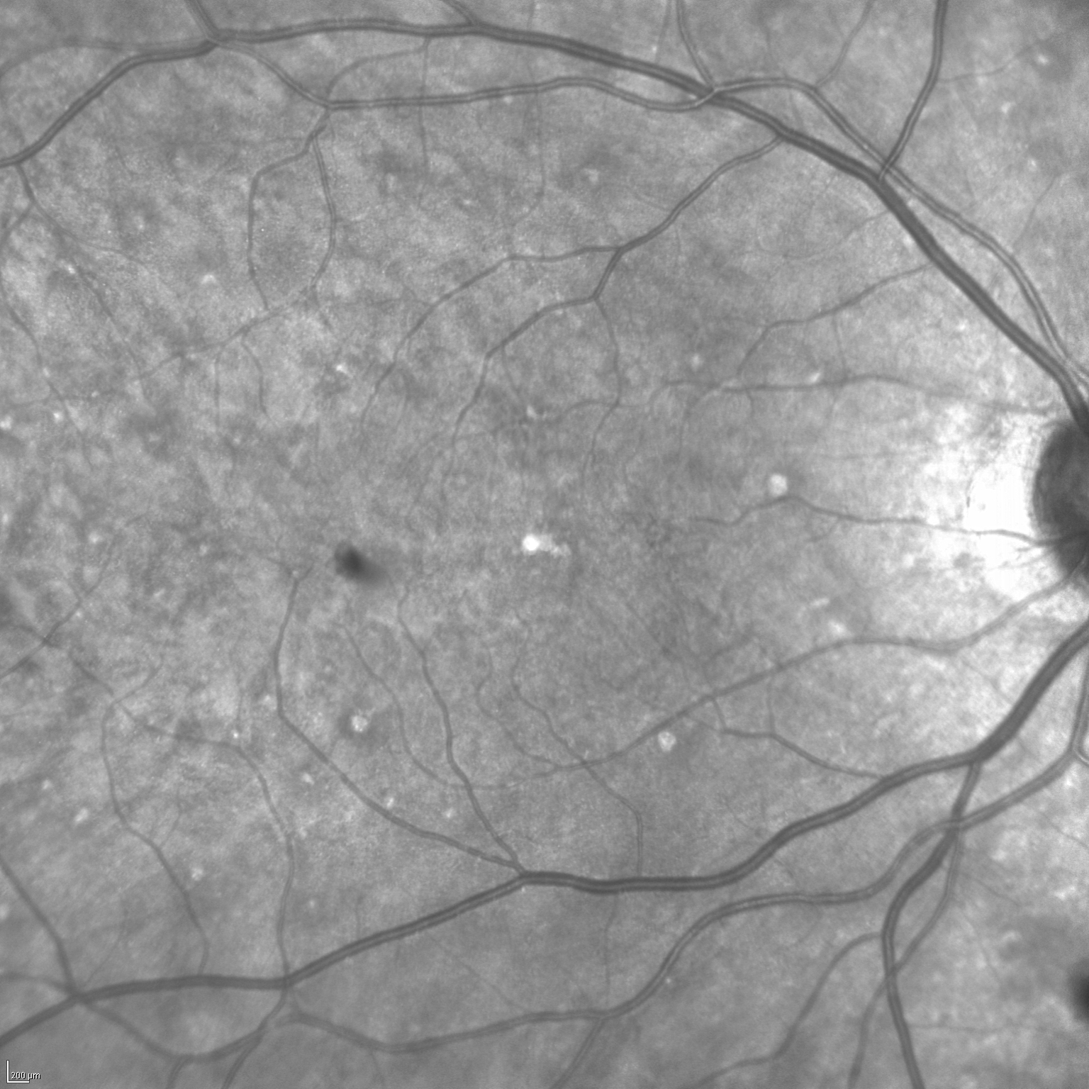 lymphome lymphoblastique type t