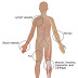 Soft tissue sarcoma-patient version