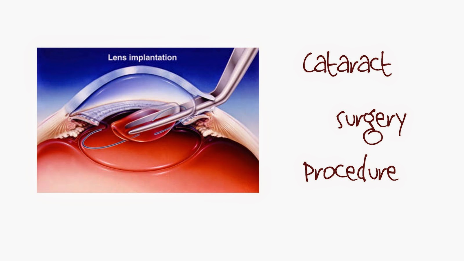 Cataract Surgery Delhi
