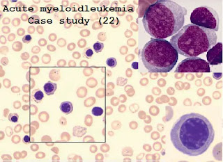 Case study (22)- Acute phase acute myeloid leukemia with severe anemia and thrombocytopenia