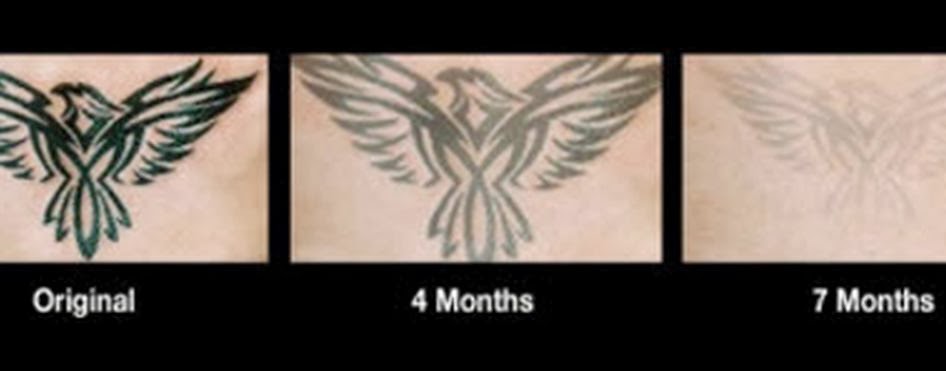 tattoo removal cream, before and after photos of tattoo removal cream ...