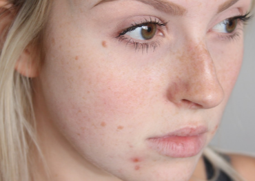 How to Get Rid of Acne,