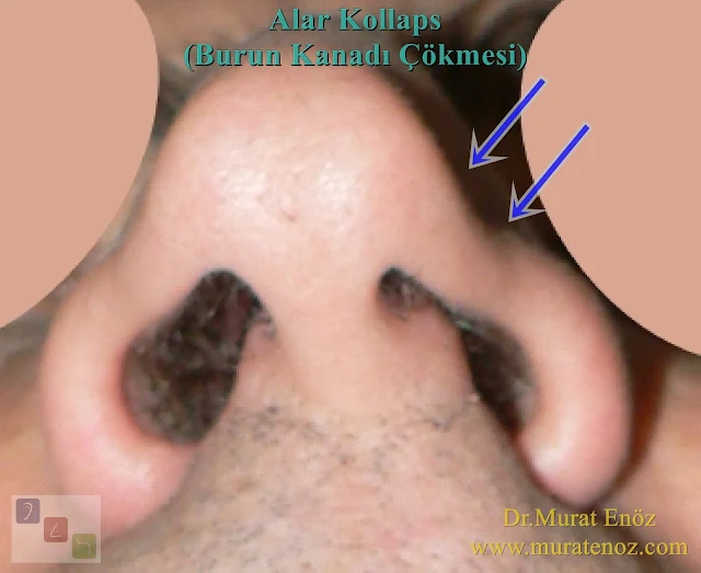 Nasal valve definition -  Nasal valve collapse - Nostril collapse - Alar collapse - Treatment of nasal valve collapse - Treatment of alar collapse - Nasal valve collapse surgery - Repair of nasal valve collapse - Nasal valve collapse operation