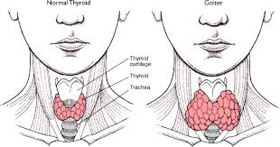  goiter causes and symptoms and treatment