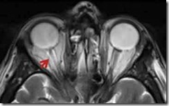 MRI-opticNerve