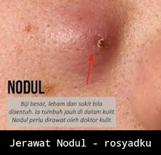 Jerawat nodul