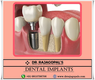 Dental implants in Gurgaon, Dental implant treatment in Gurgaon