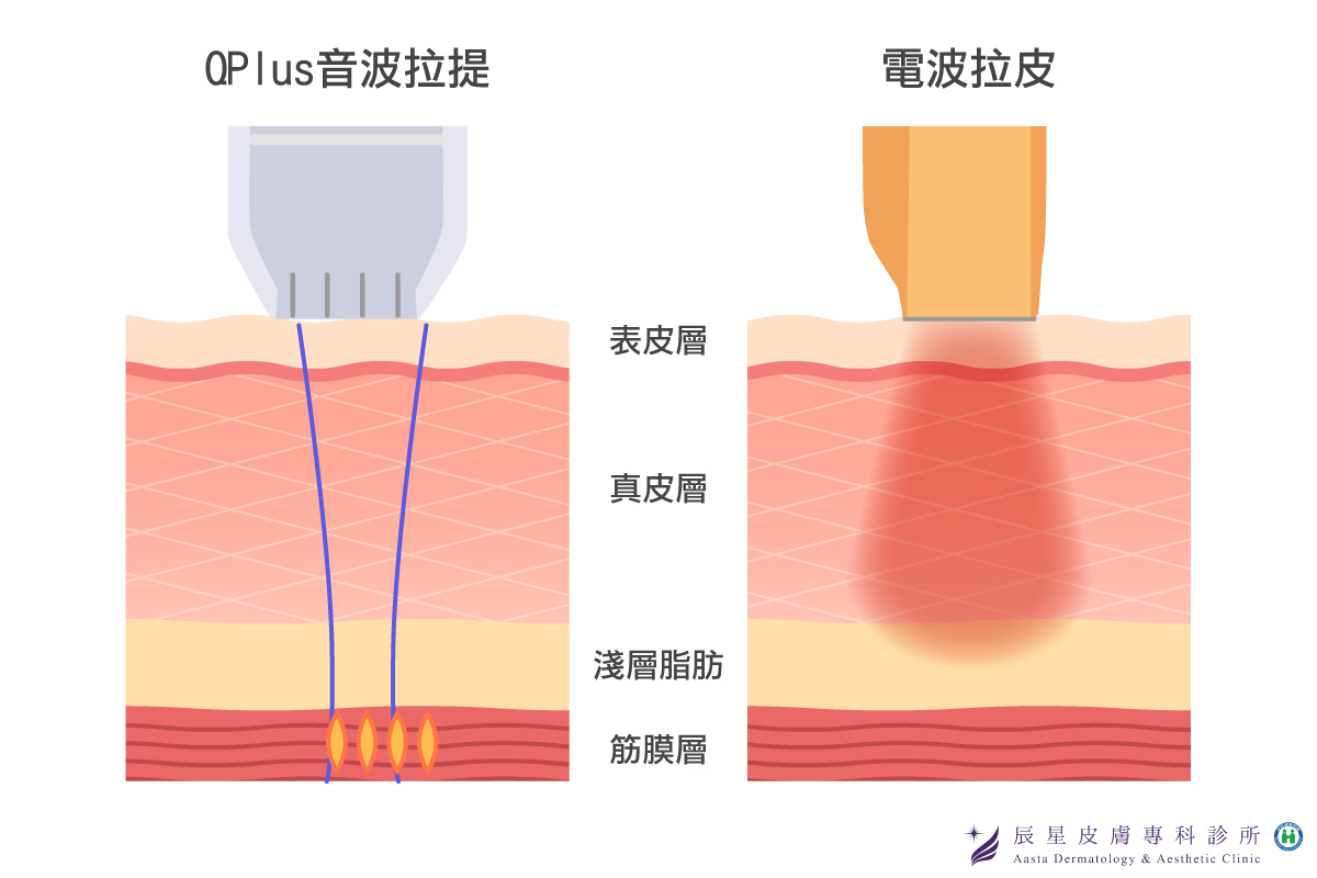 Q+音波拉提 效果