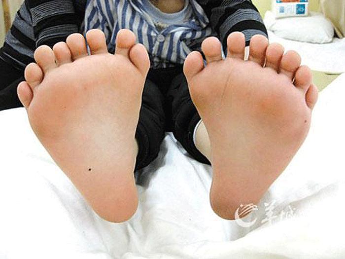 Polydactyly (extra fingers or toes) Causes, Treatment and ...