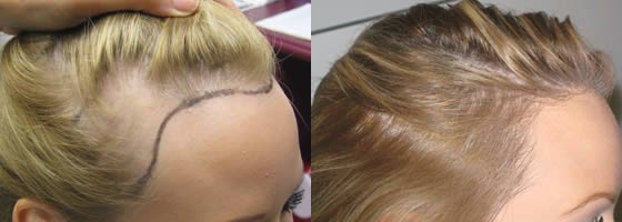  Haartransplantation bei Frauen