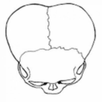 Пример андского доиспанского черепа с «боковым искажением».