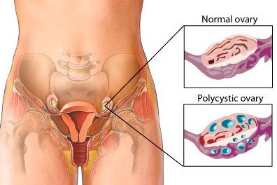 8 Early Warning Signs Of Ovarian Cancer You Shouldn't Ignore 