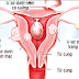 U xơ cổ tử cung, dấu hiệu và cách điều trị