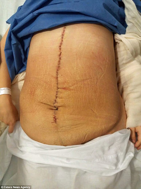 24-Year-Old Woman Has the World's Biggest Cyst Removed After Her Organs Were Crushed