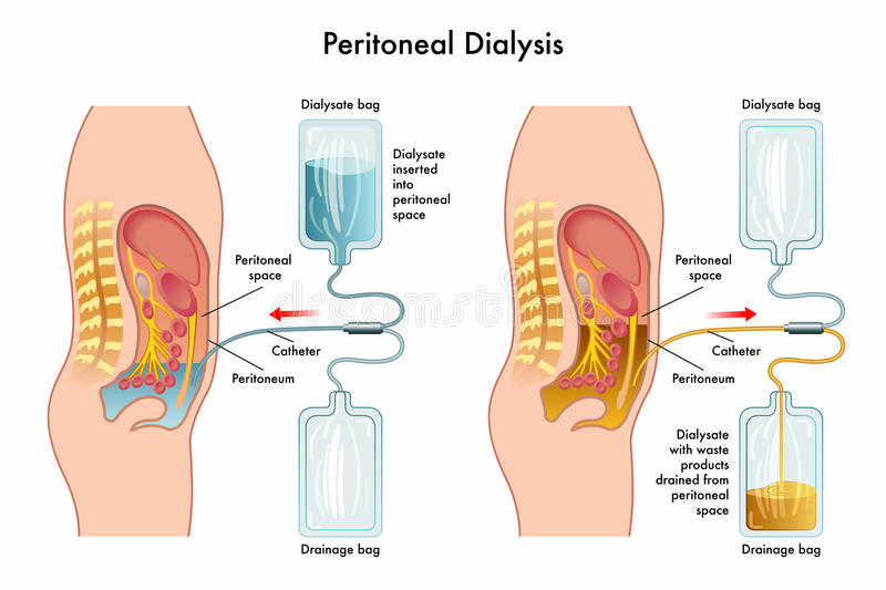 Interesting Green: Dialysis - How it's performed