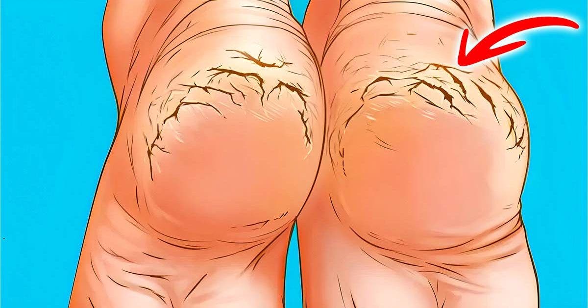 Dry feet and cracked heels? The magic trick to repair them and make them soft in minutes