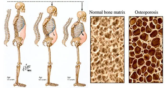 This Common Food Destroys Your Bones From The Inside But Everyone Drinks It Every Day!