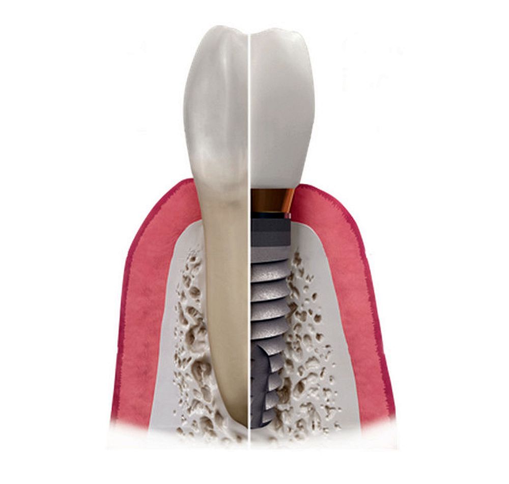 Implantes dentales