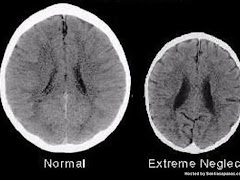 Otak Kanak-kanak Terabai Lebih Kecil Dan Tidak Berkembang