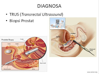 penyebab pencegahan pengobatan kanker prostat