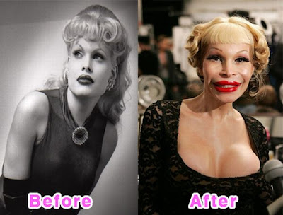 Celebrity Plastic Surgery Disasters