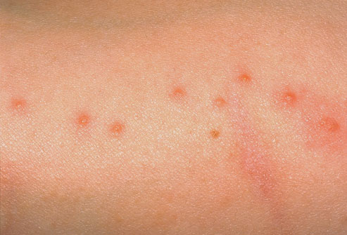 What Do Bed Bug Bites Look Like