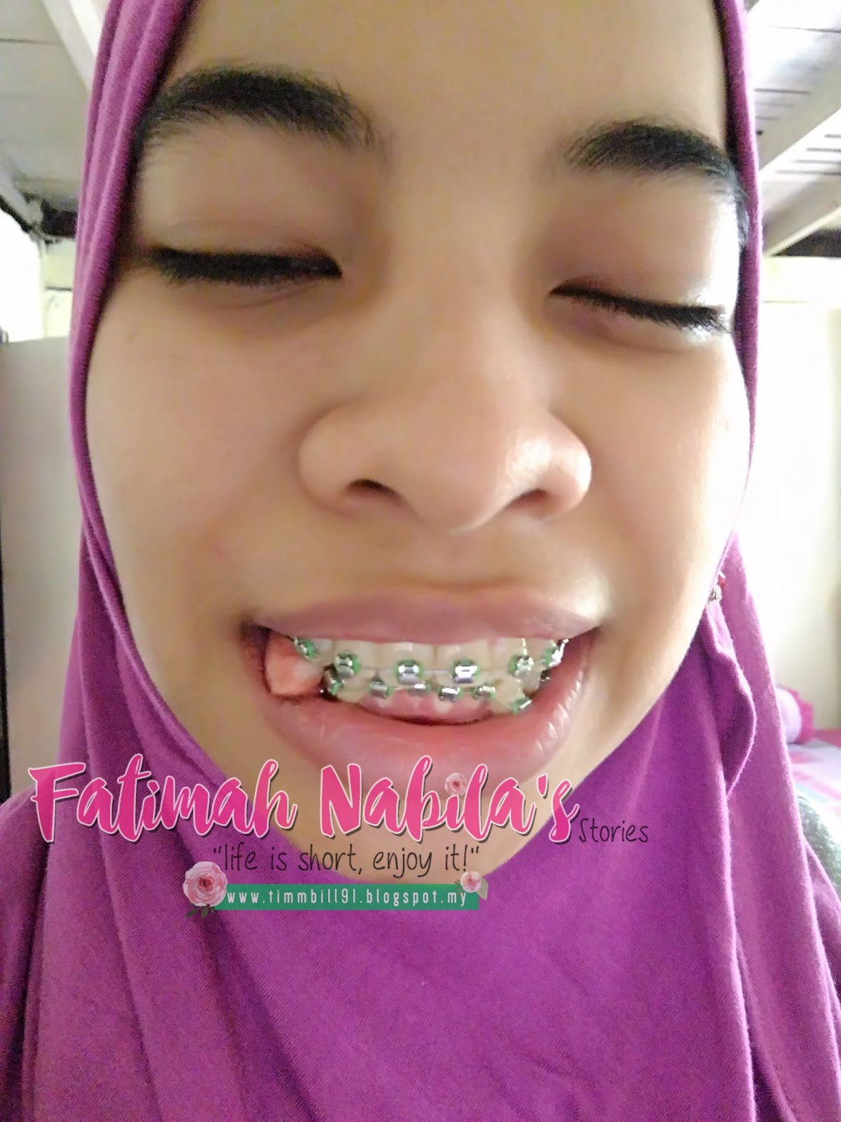 Pengalaman Mencabut Gigi Untuk Prosedur Braces  fatimahnabila