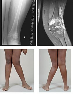 Valgus , safraña , rodilla , ginoll ,genoll