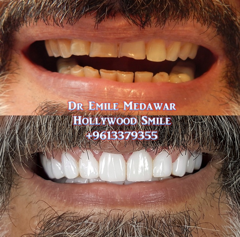 Teeth whitening ultra smile