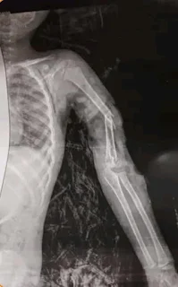فريق طبي بمستشفي سوهاج الجامعي ينقذ ذراع طفل من "بتر" كامل