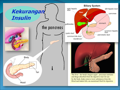 Kekurangan Insulin