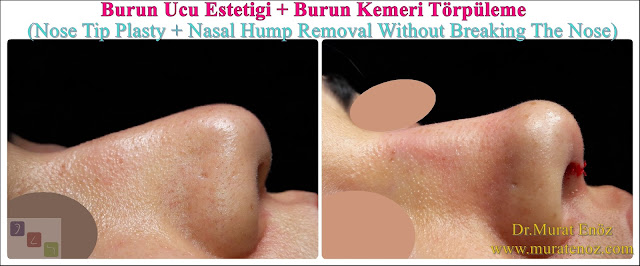 Burun Ucu Estetiği + Burun Kemeri Törpüleme (Nose Tip Plasty + Nasal Hump Removal Without Breaking The Nose)