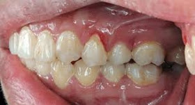 Gingivitis gingival bleeding in need of dental cleaning