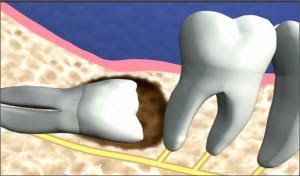 Tác hại của răng khôn mọc lệch và mọc ngầm là gì?