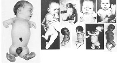 Thalidomide victims