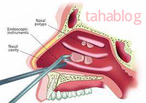 নাকের পলিপাস অপারেশন খরচ - বিনা অপারেশনে নাকের পলিপাস চিকিৎসা
