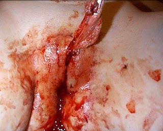 Saat dan setelah Mutilasi klitoris 1